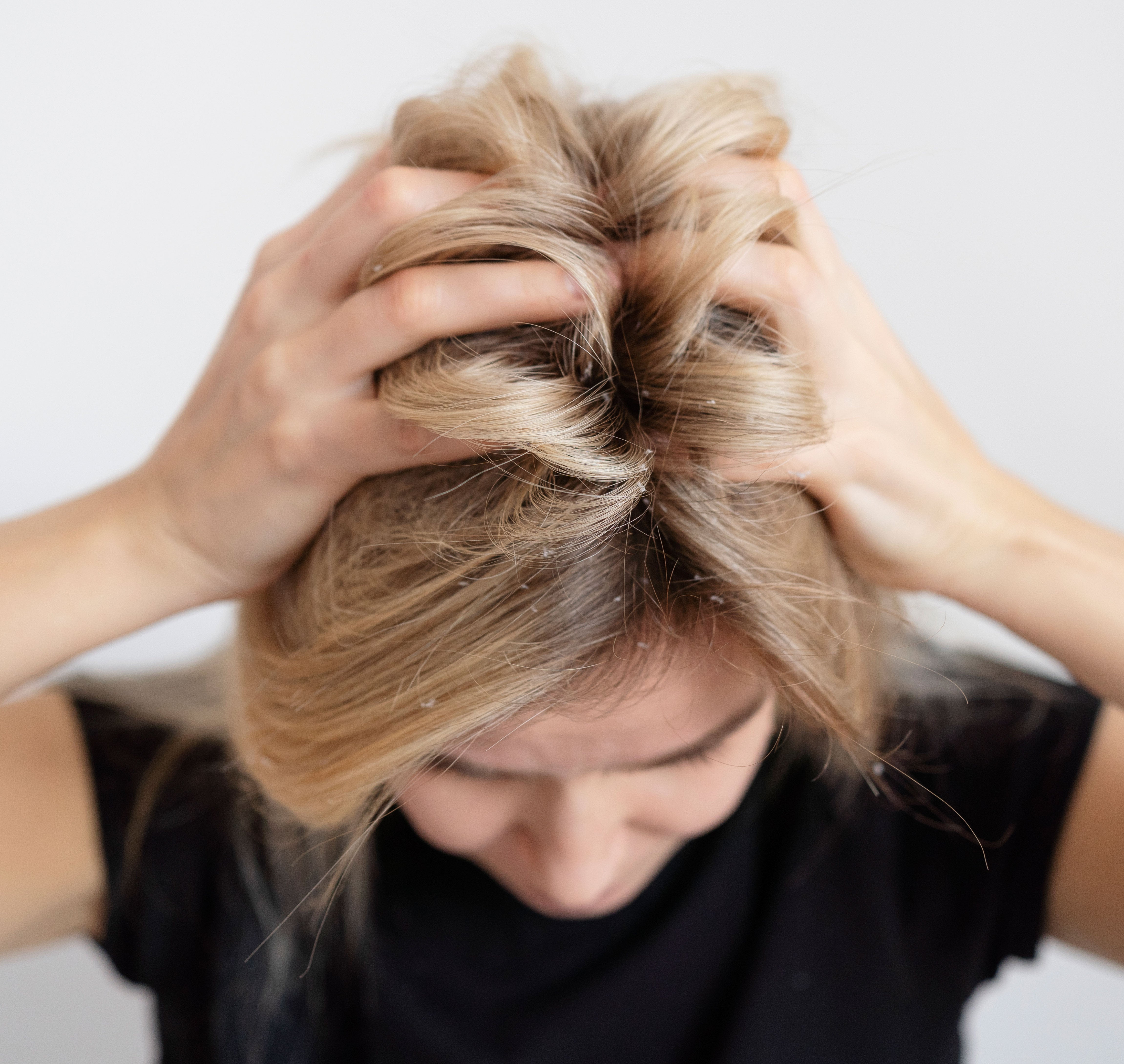 Common Hair problems and its Prevention