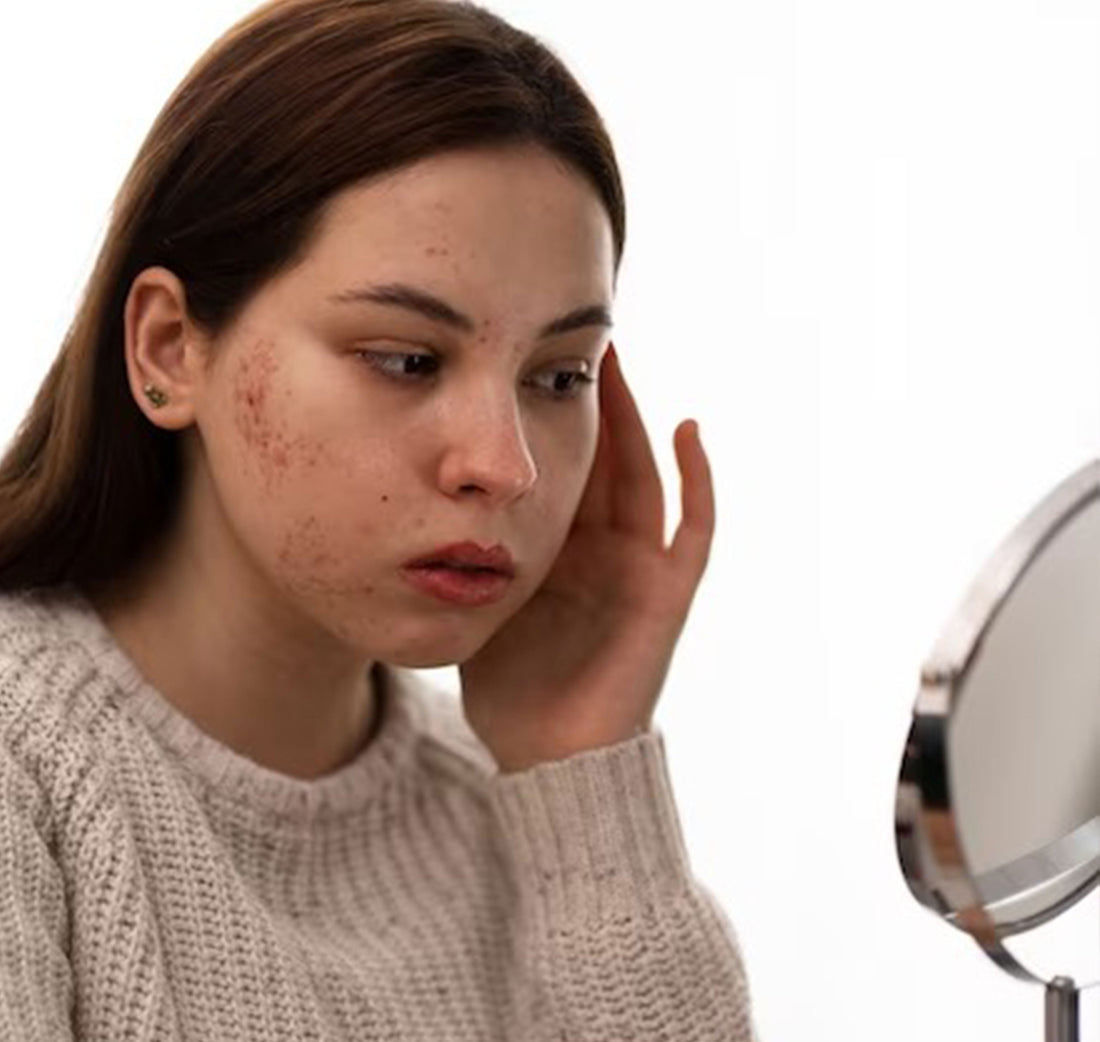 Some common skin issue in the Winter - Adven