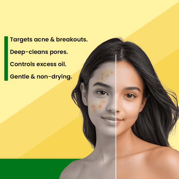 Adven Naturals D - Acne Soap - Adven